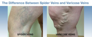 Side by side images of woman’s legs with spider and varicose veins
