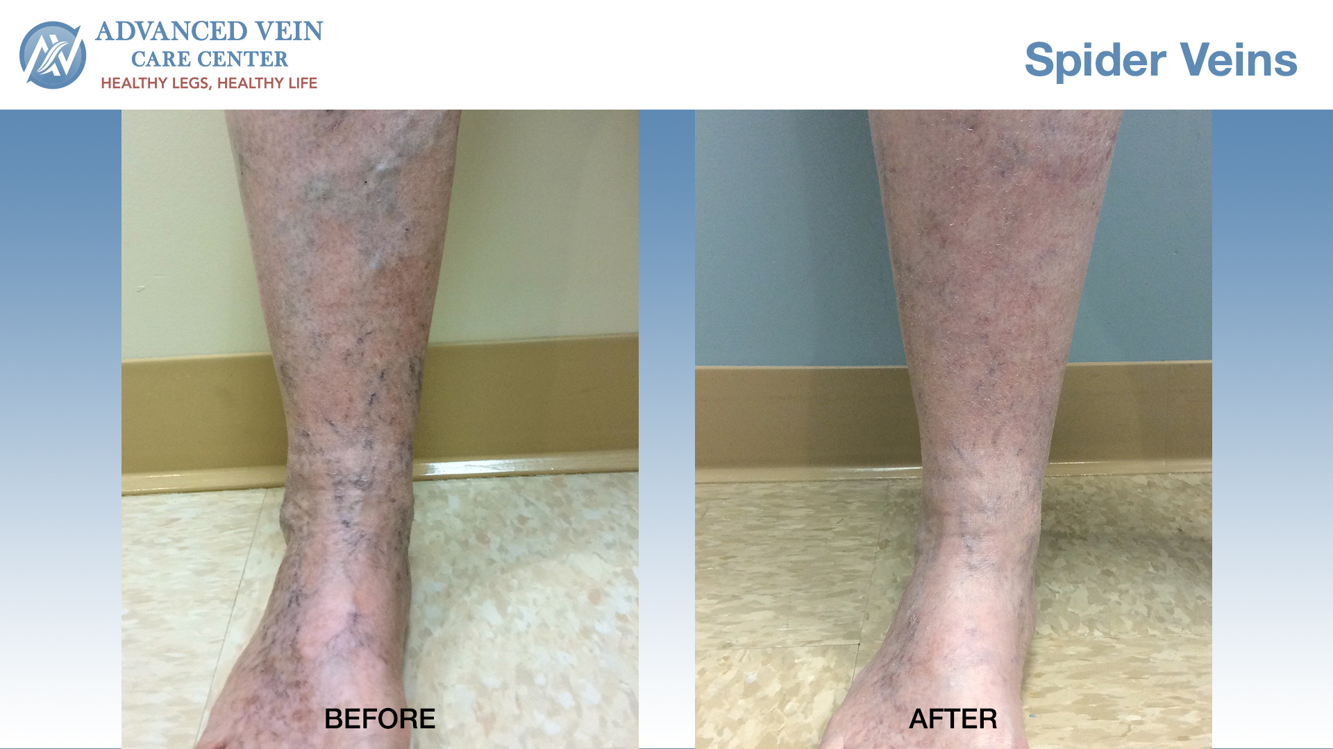 Spider Veins Before After front of leg